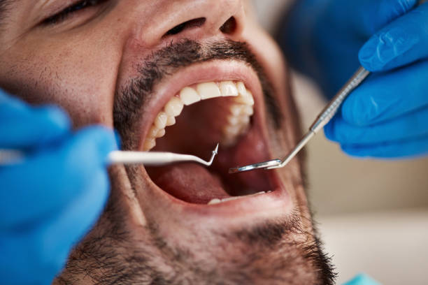Best Emergency Root Canal Treatment in Sparks, TX