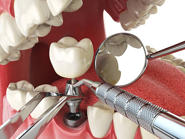 Best Emergency Tooth Extraction in Sparks, TX